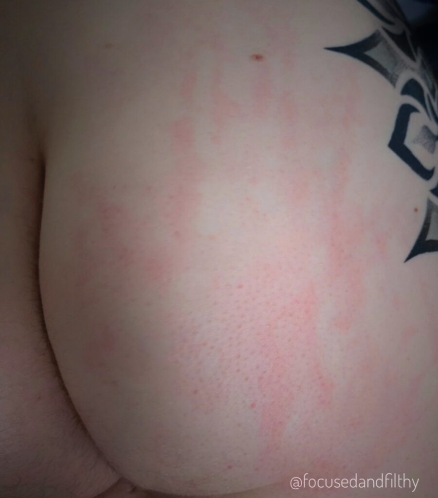 A close up photo of my left  naked buttock which is sporting an impressive red handprint 